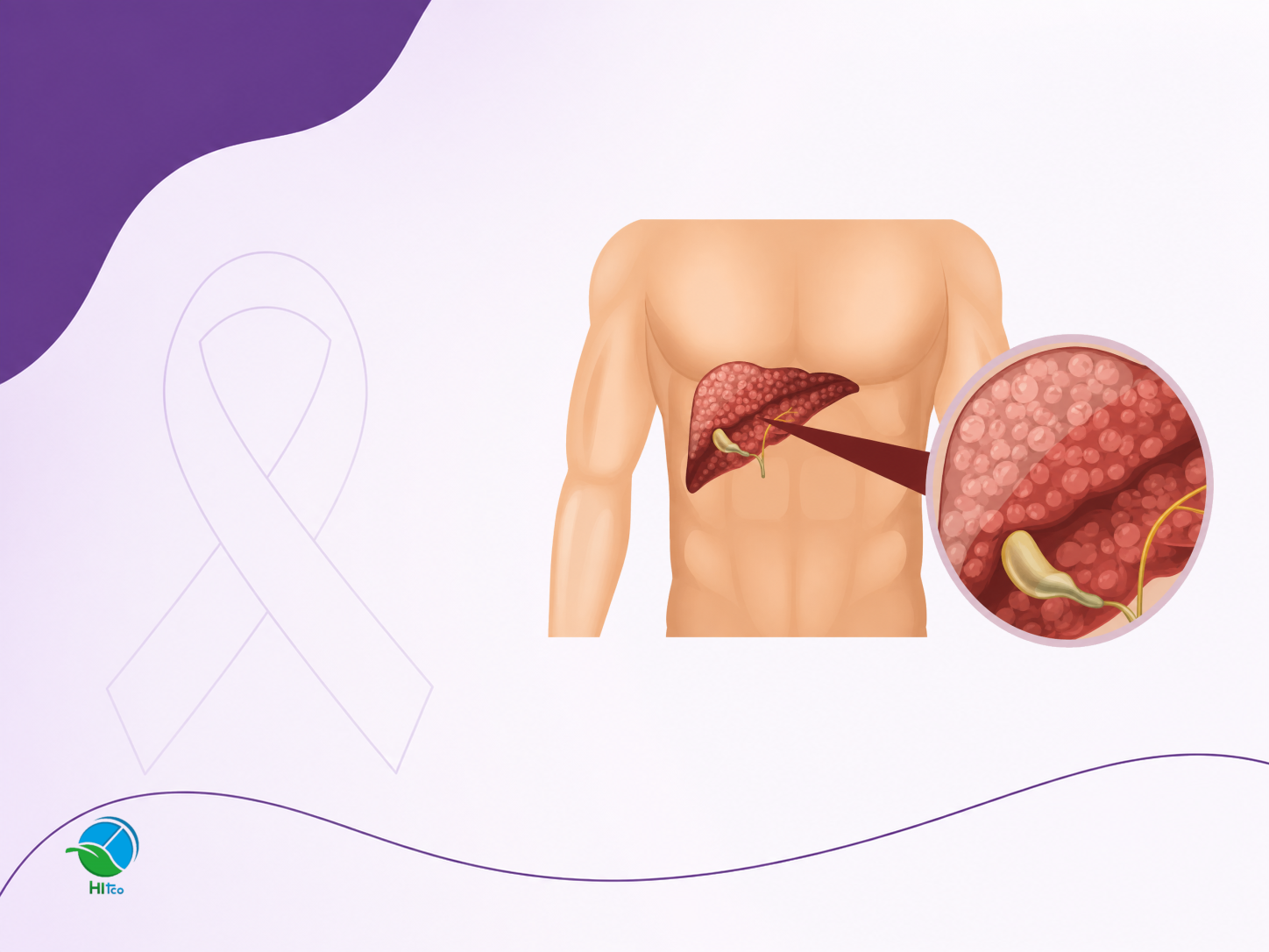 همه چيز درباره سرطان کيسه صفرا؛ علل، علائم، تشخيص و درمان